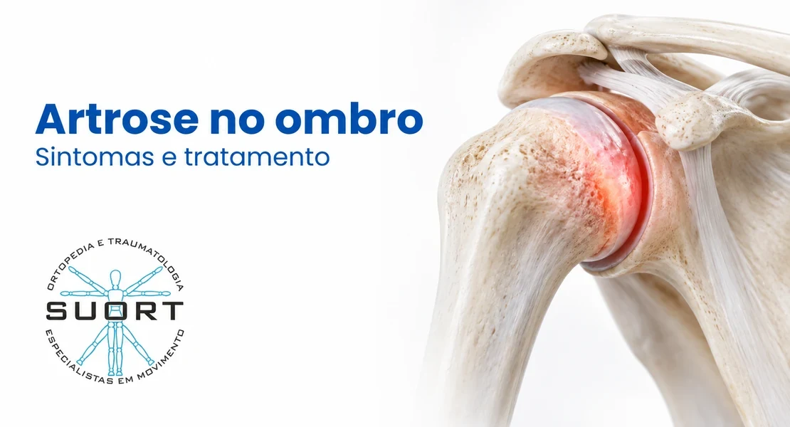Artrose no ombro, desgaste da articulação glenoumeral, avaliada por ortopedista de ombro na SUORT Clínica Integrada em Perdizes, São Paulo