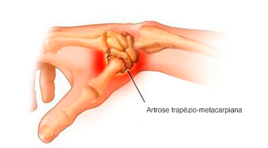 artrose