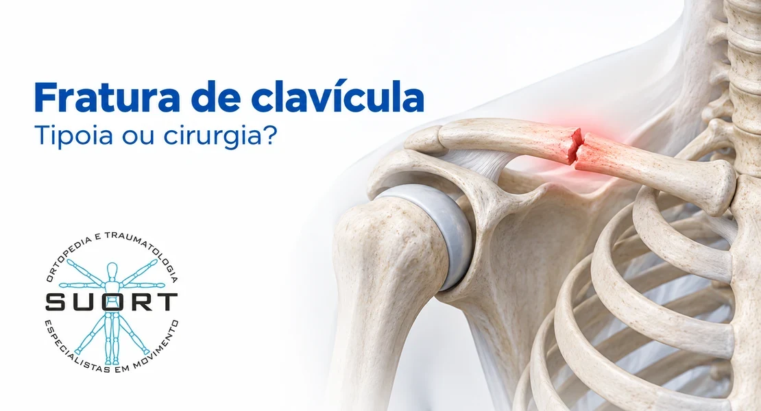 Fratura de clavícula, tratamento com tipoia ou cirurgia com placa, avaliação com ortopedista de ombro na SUORT Clínica Integrada, Perdizes, São Paulo