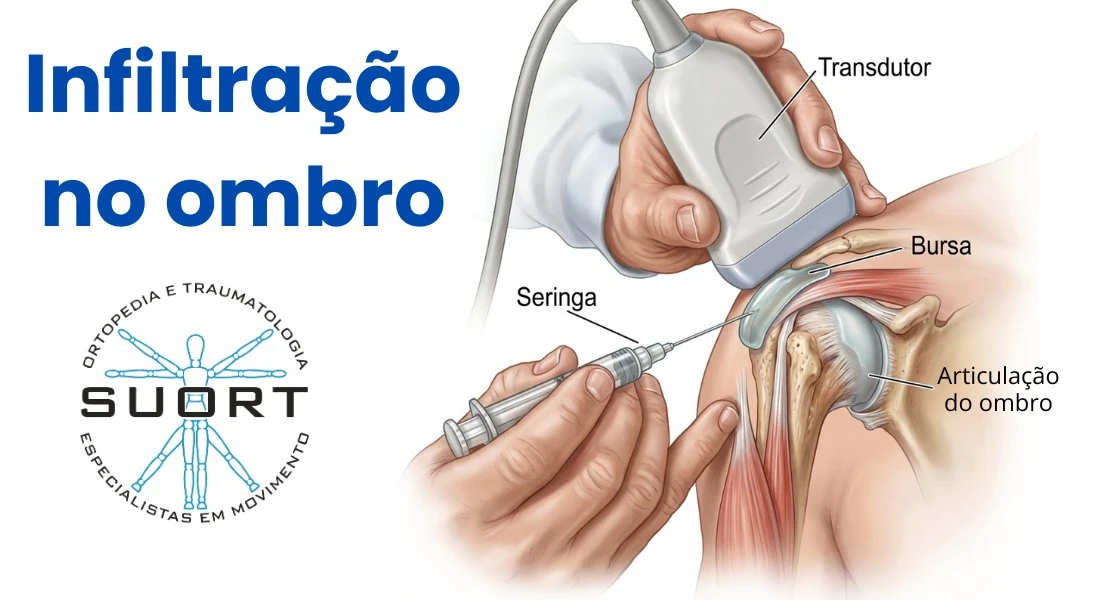 Infiltração no ombro com ácido hialurônico guiada por ultrassom — Clínica Suort, Perdizes, São Paulo