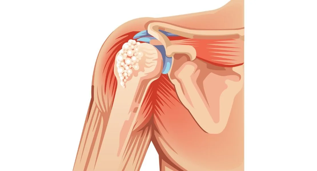 Lesão do Manguito Rotador — Dr. Sérgio Rovinski, Clínica Suort