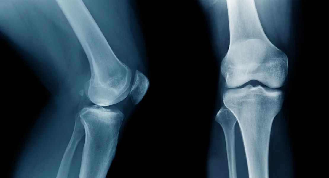 Cirurgia de Joelho com Robô